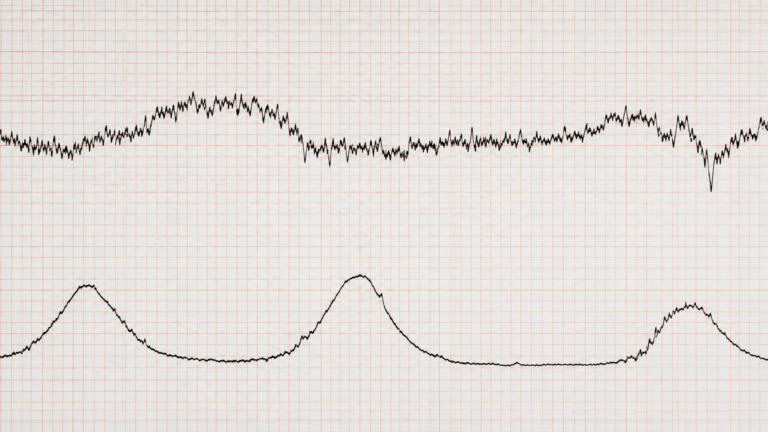 Cardiotocografia Anteparto