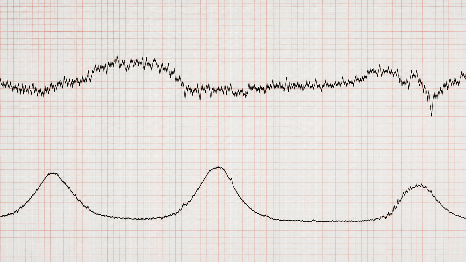 Cardiotocografia Anteparto