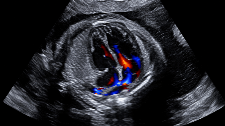 Ecocardiografia Fetal